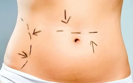 Le prestazioni di chirurgia estetica sono esenti da IVA se hanno finalità terapeutica